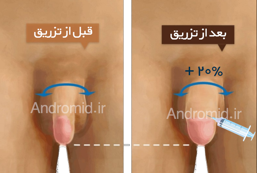 عوارض تزریق ژل به اندام تناسلی مردان+تجربه مردان از تزریق ژل به آلت